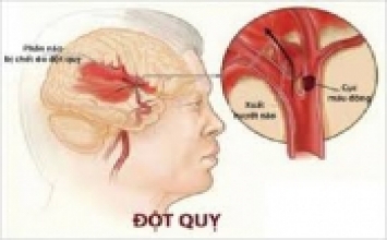 9/10 cơn đột quỵ có thể phòng tránh được